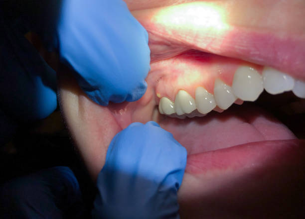 Best Emergency Care for Gum Disease in South Riding, VA